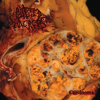 Blasted Pacreas - Carcinoma - CD